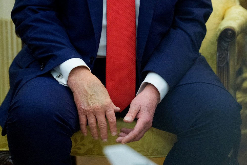 Trumpov doktor tvrdi da su modrice na ruci uzrokovane 'čestim rukovanjem'
