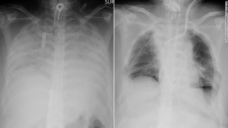 Prvi put urađena transplantacija pluća ženi oboljeloj od COVID-19