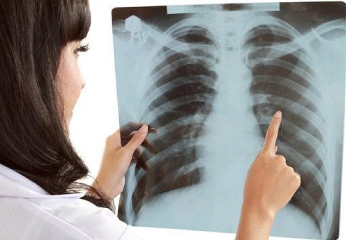 Paralija: U Federaciji BiH u 2021. godini od tuberkuloze oboljele 293 osobe