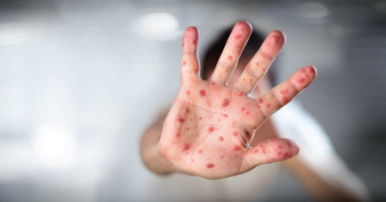 Male boginje u Srbiji: Broj imuniziranih mali, pooštrene mjere nadzora