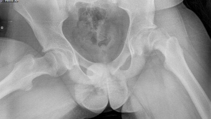 Operativni tim UKC Tuzla izveo rijedak operativni zahvat