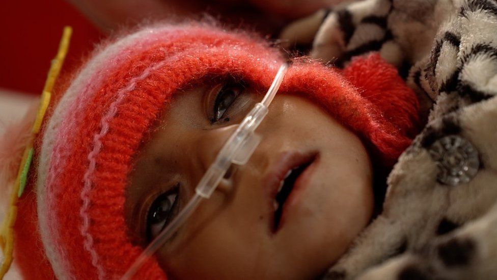 Tragedija pothranjene djece Afganistana