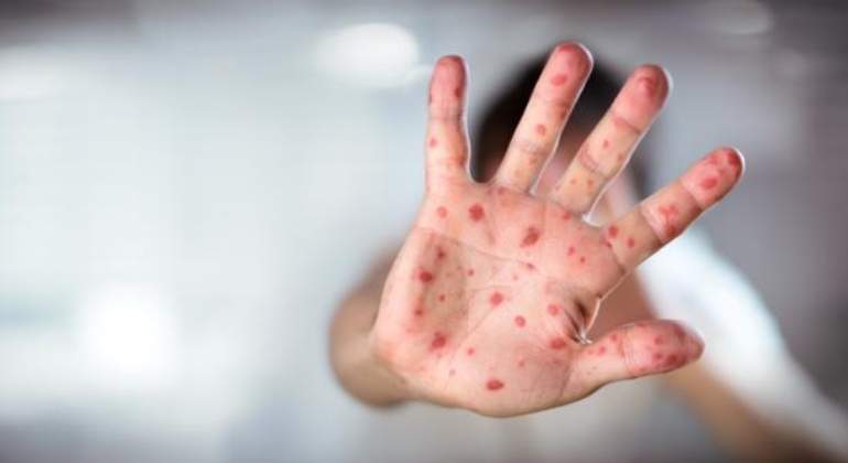 Epidemija ospica: Više od 130 djece umrlo za četiri mjeseca u Afganistanu