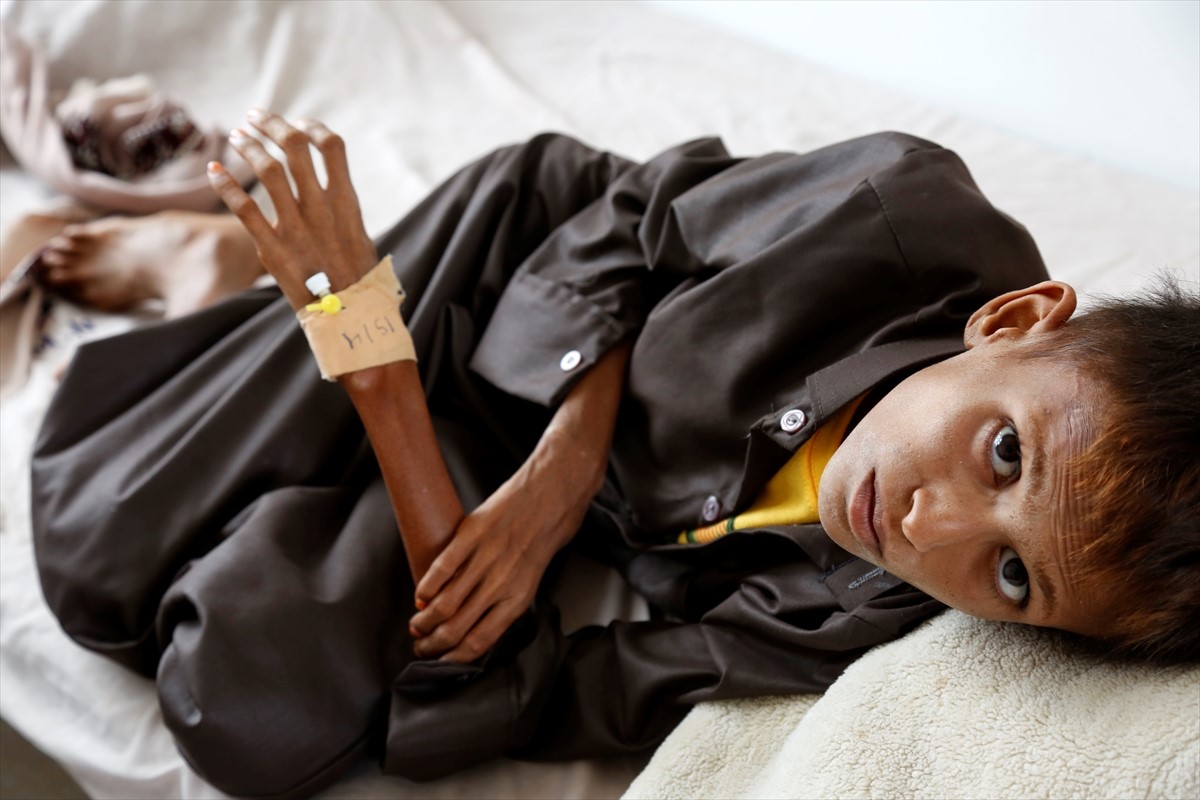 Borba za život djece koja gladuju u Jemenu