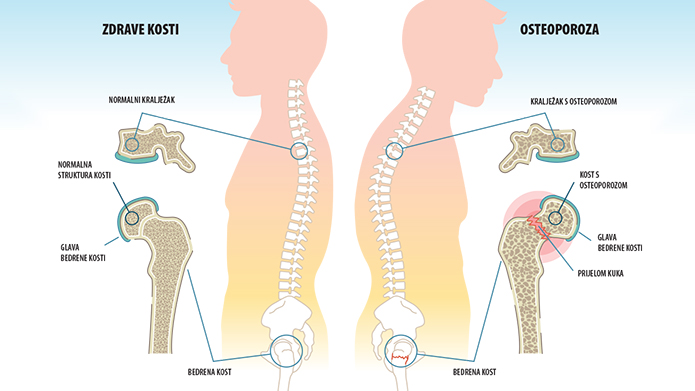 Tiha epidemija: Danas je svjetski dan osteoporoze, najčešće bolesti kostiju