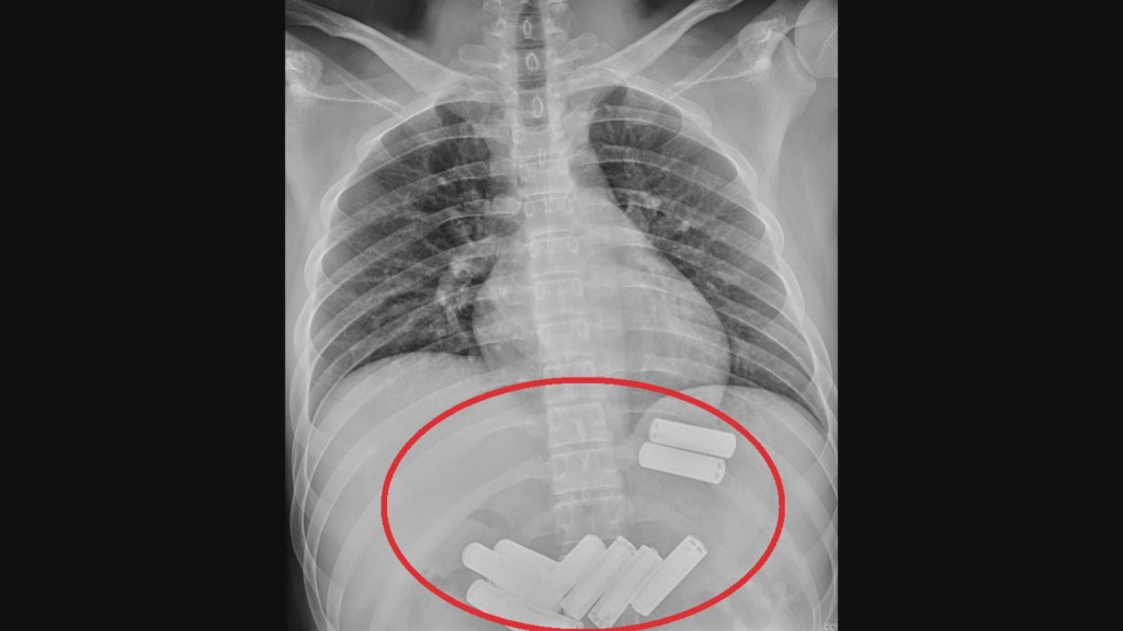 Nesvakidašnji zahvat: Mladom Kinezu iz želuca izvadili 11 baterija