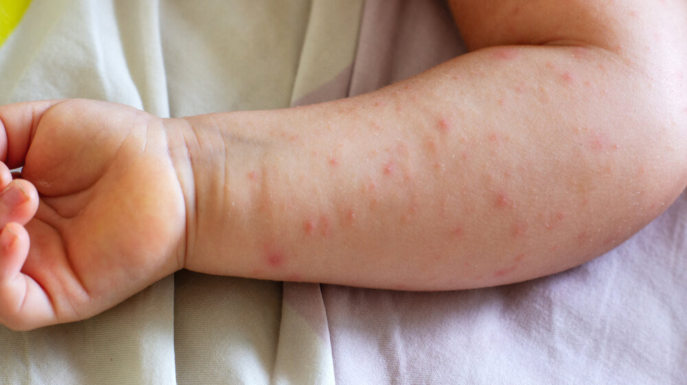 Bajramović: Morbili vrlo zarazno oboljenje, nema mjesta panici, važno vakcinisati djecu što prije