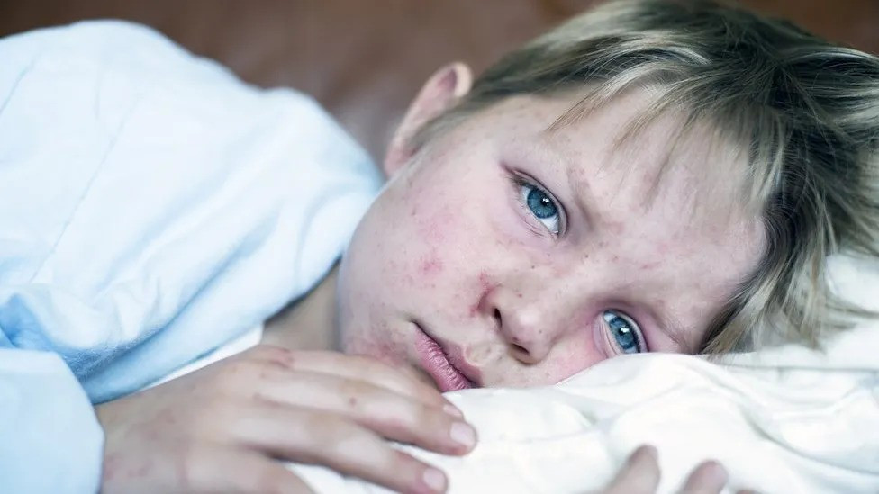 Ospice u Evropi: Oko 21.000 hospitalizacija i pet smrtnih slučajeva