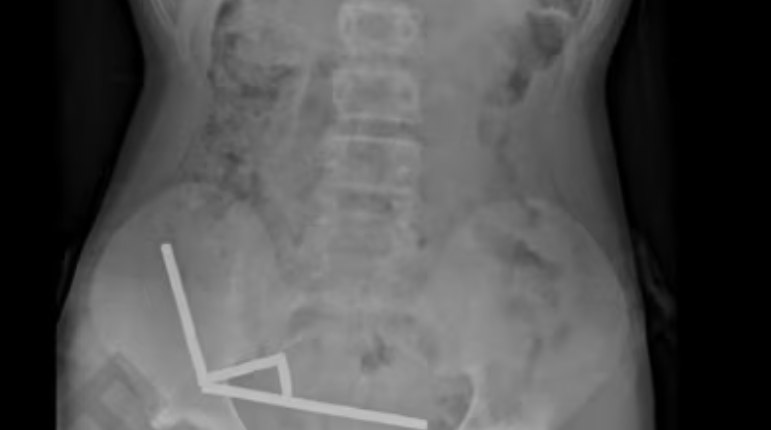 Tinejdžeru uklonjeni nekrotični dijelovi crijeva nakon što je progutao 100 magneta kupljenih online