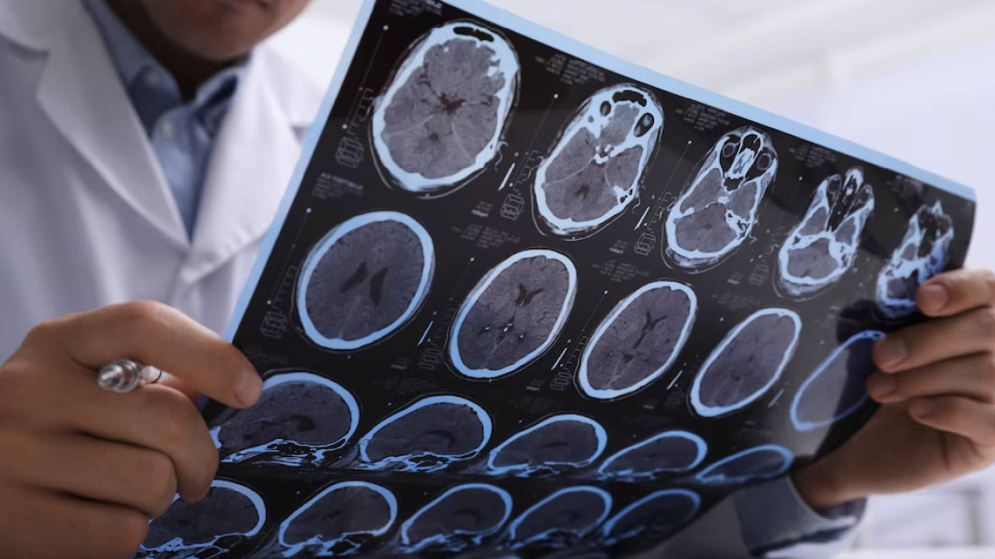 Više od 55 milijuna ljudi u svijetu boluje od Alzheimerove bolesti