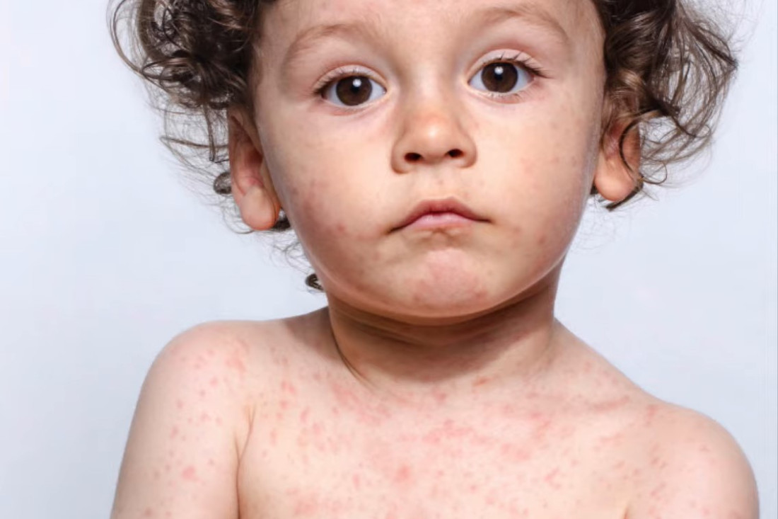 Ministarstvo zdravstva, rada i socijalne skrbi HNK upozorava na pojavu morbila