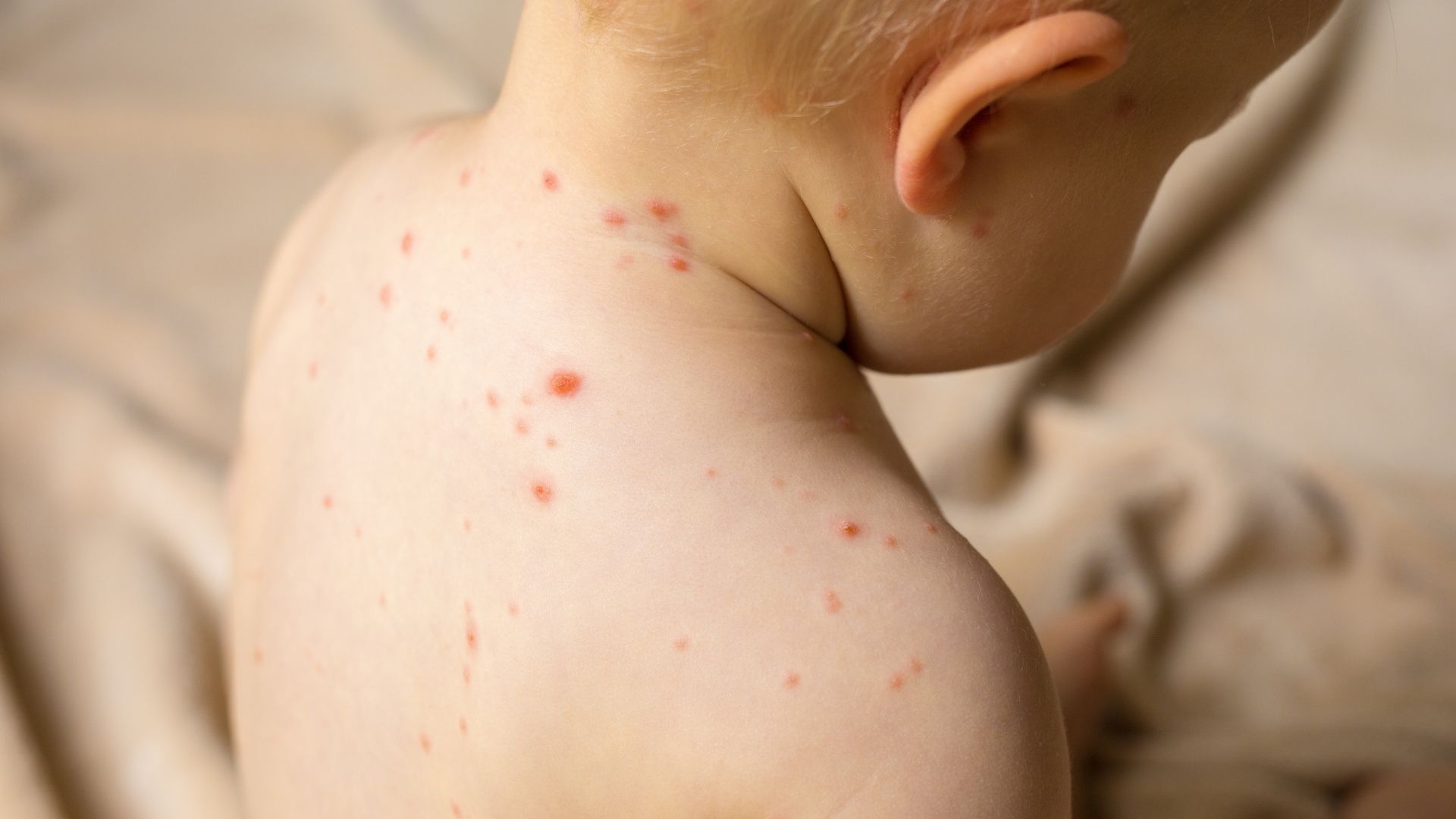 Zbog slabe imunizacije milioni djece na svijetu mogli bi oboliti od morbila