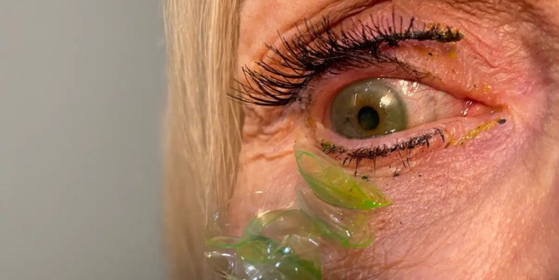 Starijoj ženi u SAD-u iz oka izvađene 23 kontaktne leće