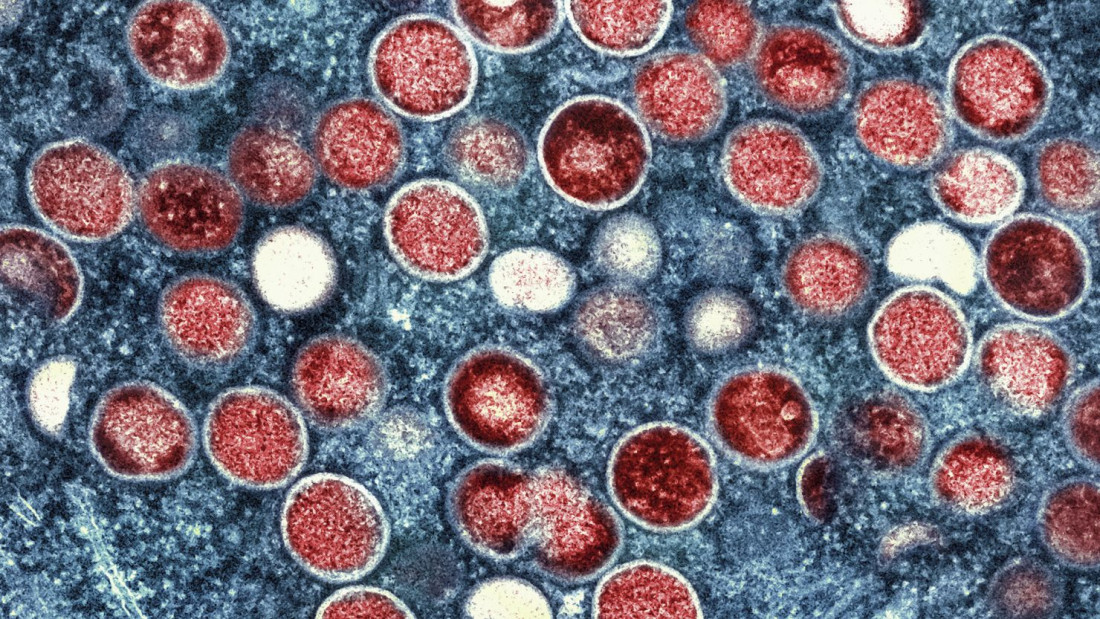 Švedska prva zemlja van Afrike s registrovanim slučajem majmunskih boginja