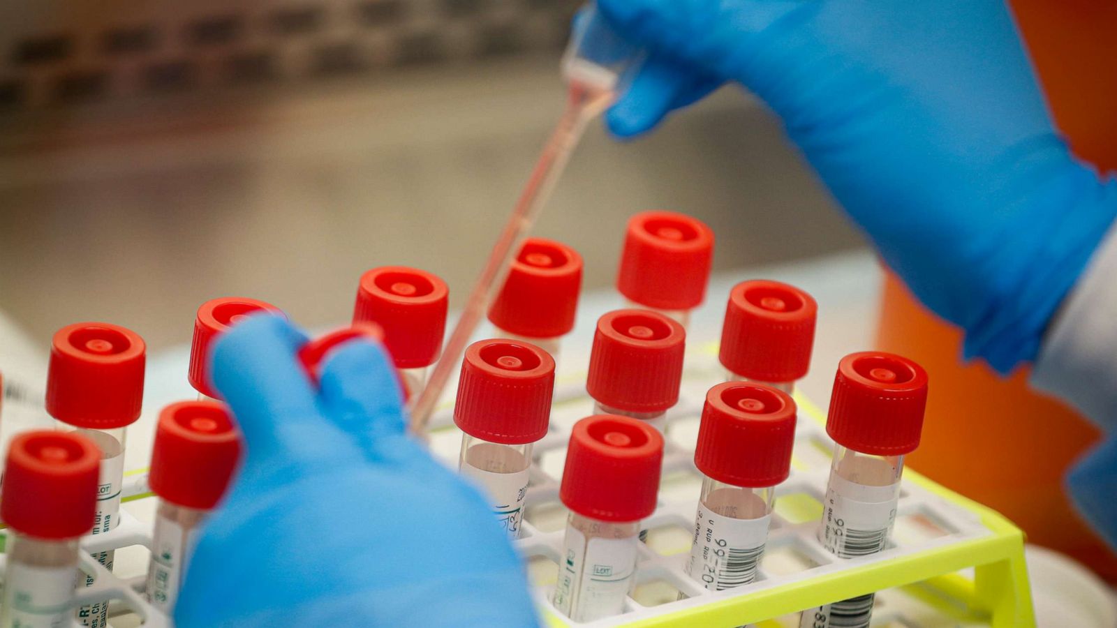 Broj zaraženih koronavirusom u svijetu premašio 94 miliona