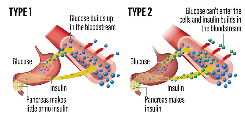 Oko 537 miliona odrasle populacije u dobi od 20 do 79 godina ima dijabetes