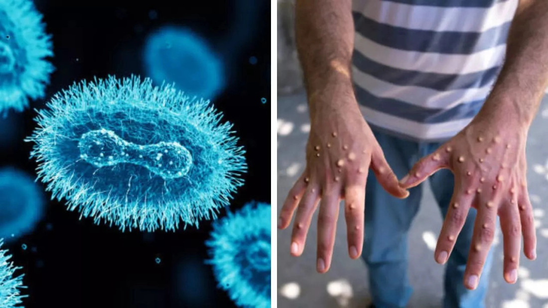 U DR Kongo od virusa majmunskih boginja umrlo najmanje 570 ljudi