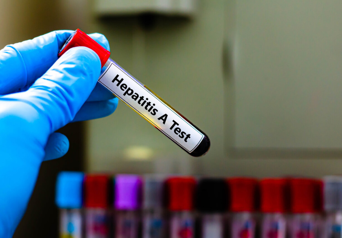 Prag bilježi porast broja slučajeva hepatitisa A, prijavljena nestašica vakcina