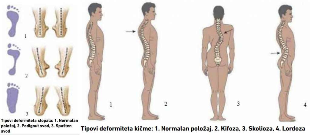 Sve više učenika ima problem s lokomotornim sistemom
