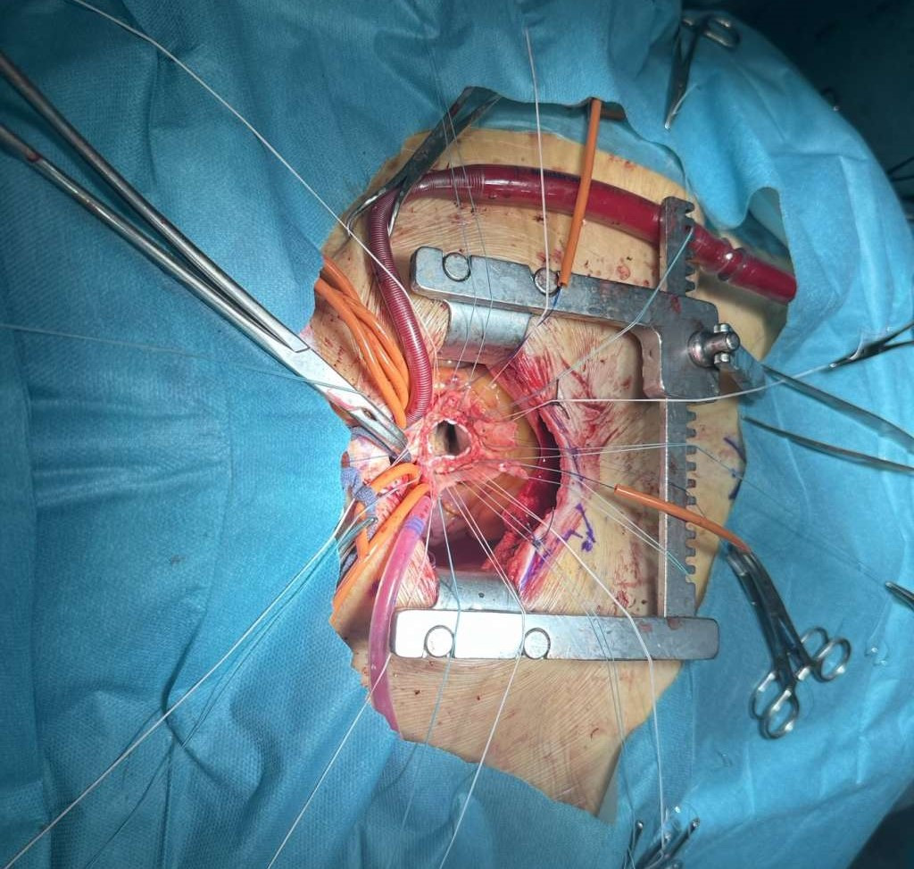 Nove minimalno invazivne procedure u UKC Tuzla