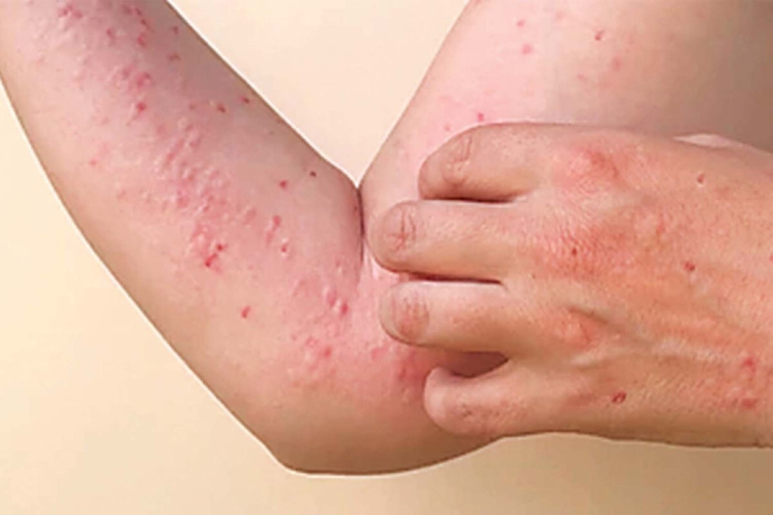 Na Filipinima dva nova slučaja majmunskih boginja