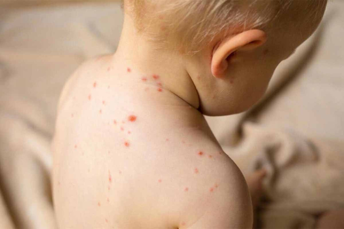 U RS-u upaljeni alarmi: Jedan oboljeli od morbila zarazi i do 18 osoba