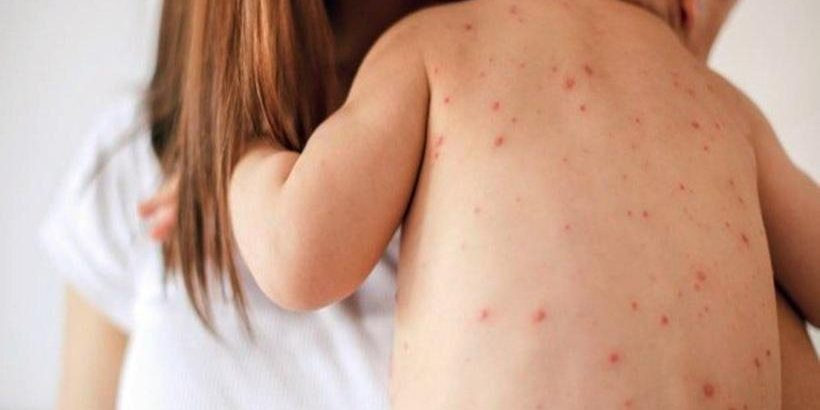 Epidemija ospica u Bangladešu: Broj umrle djece porastao na 991