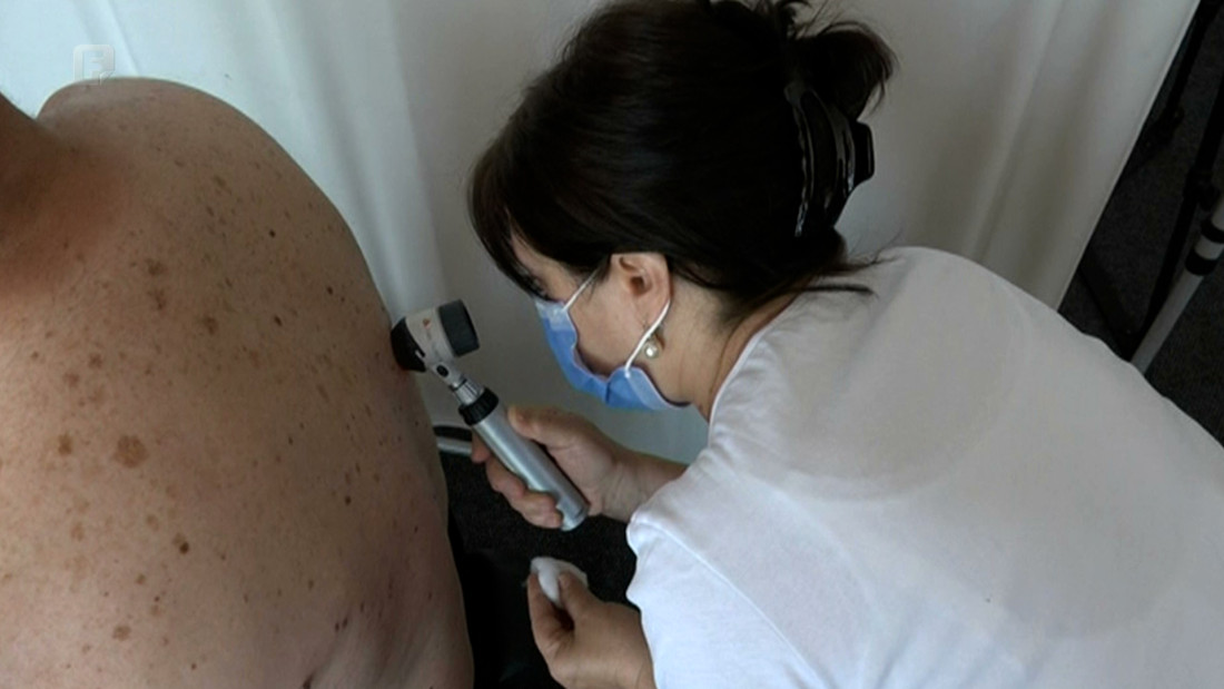 Bosna i Hercegovina nema registar oboljelih od melanoma kože