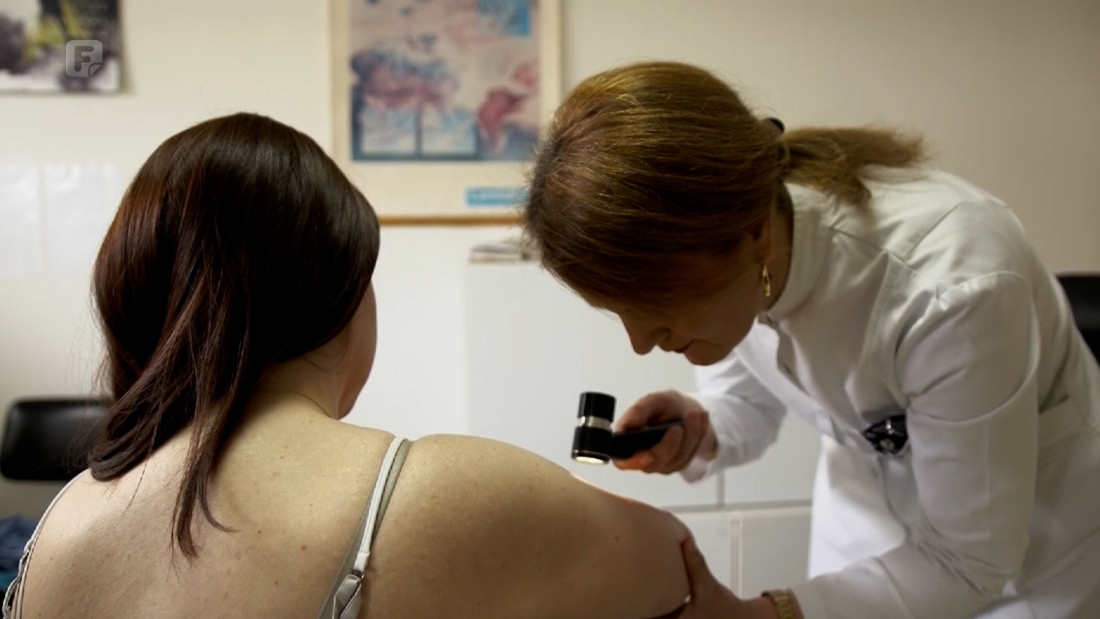 Bihaćka bolnica besplatnim pregledima ukazuje na važnost prevencije melanoma