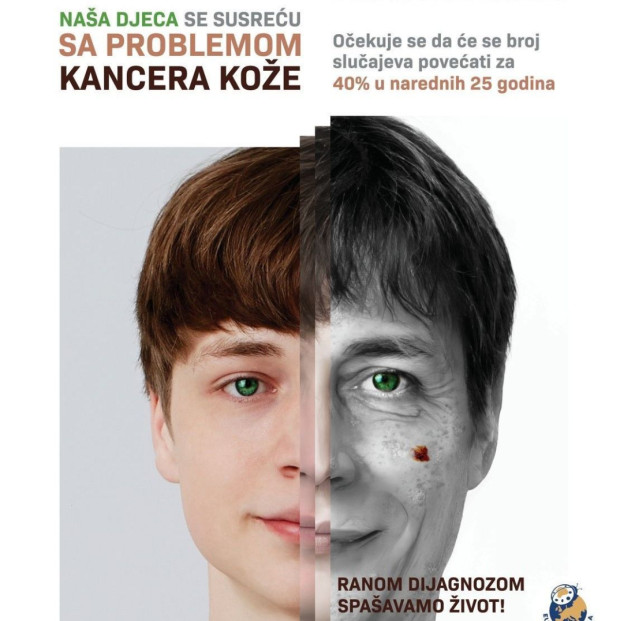 U FBiH godišnje se dijagnosticira oko 250 novih slučajeva melanoma