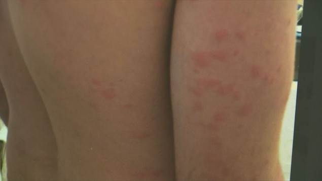 Veliki broj turista u Hrvatskoj traži pomoć nakon ugriza grinja