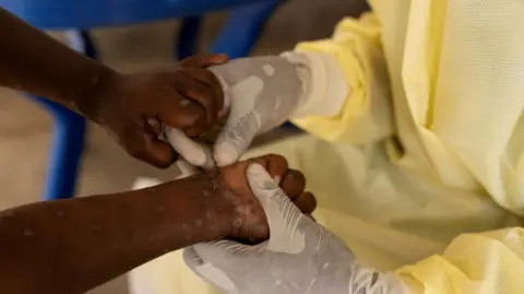 U Nigeriji ove godine otkriveno 39 slučajeva virusa majmunskih boginja