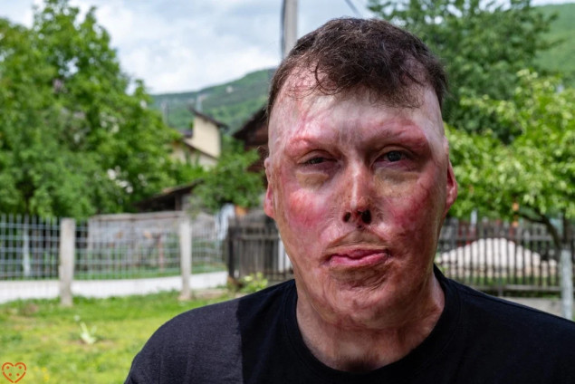 Udruženje Pomozi.ba pokrenulo apel za liječenje Aldina Jacića