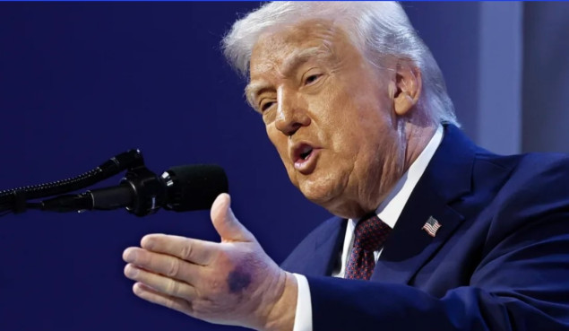 Trump tvrdi da je modrica na ruci posljedica uzimanja aspirina, a ne povrede