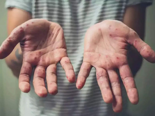 Portugal od augusta registrovao 29 slučajeva majmunskih boginja