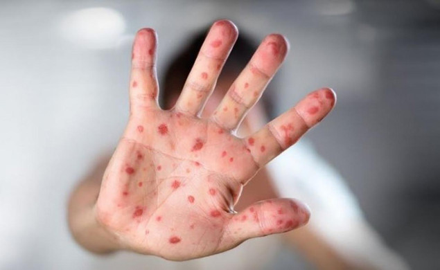 Proglašena epidemija morbila u ZDK-u