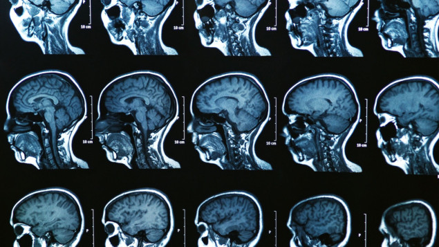 Novi lijek usporava kognitivni pad kod pacijenata s Alzheimerom