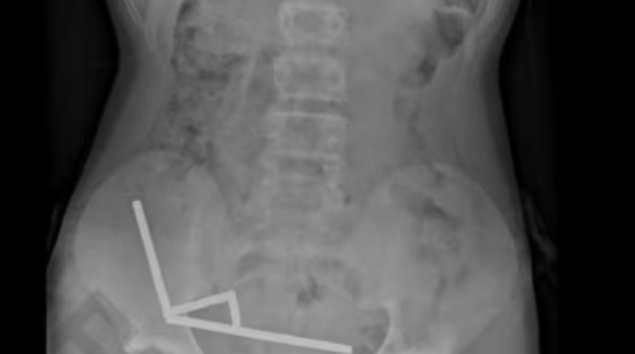 Tinejdžeru uklonjeni nekrotični dijelovi crijeva nakon što je progutao 100 magneta kupljenih online