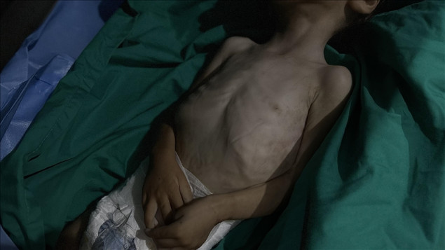 Broj umrlih od gladi u Gazi porastao na 428 dok Izrael drži prelaze zatvorenim