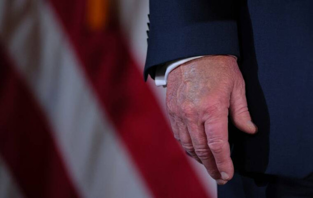 Trumpu dijagnostikovana hronična venska insuficijencija
