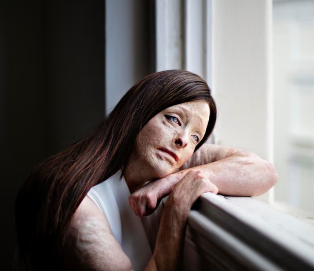 Nagrađena fotografija Martine Holmberg: Vidljivost diskriminacije s kojom se suočavaju osobe sa fizičkim razlikama