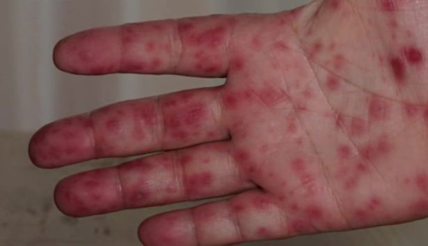 Južna indijska država prijavila slučajeve "paradajz gripa"